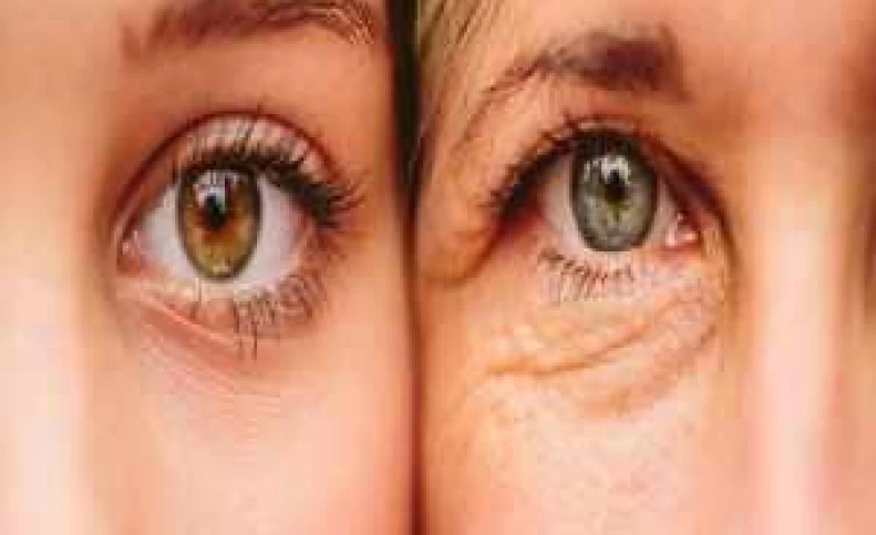 چروک های پوست صورت از یک بیماری مرگبار خبر می دهند؟