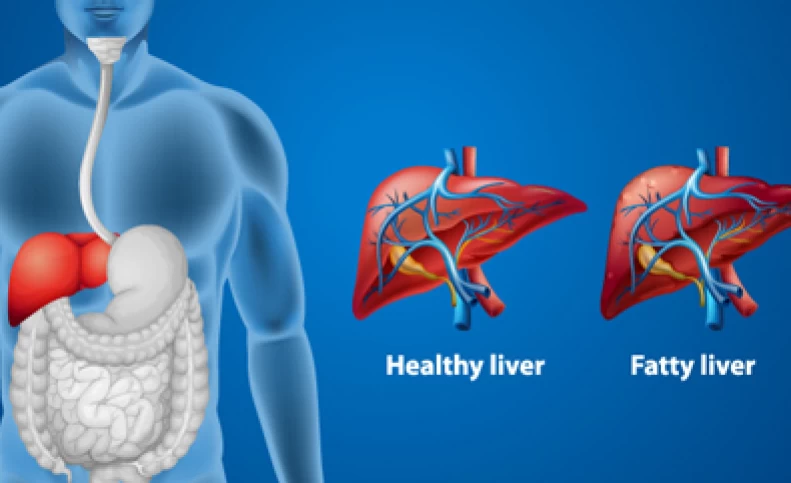 با این رژیم شانس ابتلا به کبد چرب را کاهش دهید