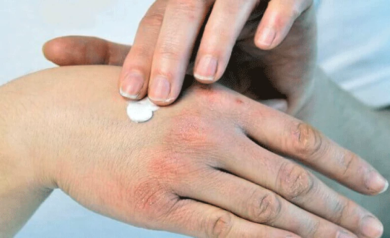 محافظت از خشکی پوست در زمستان