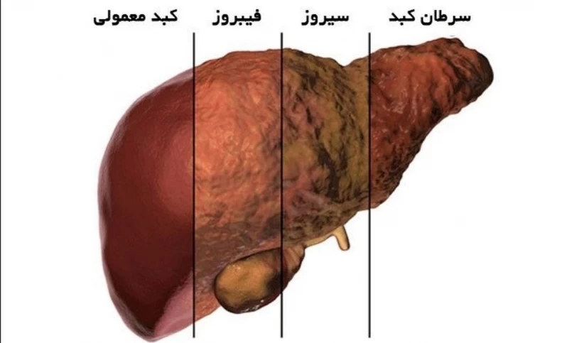 هر شش ماه برای بررسی سلامت کبد آزمایش بدهید/ لوله قلیان به انواع قارچ‌ها آلوده است/ چه مواد غذایی منجر به کبد چرب می‌شود؟