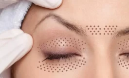 سیر تا پیاز پلاسما جت و درمان افتادگی پلک + نکات